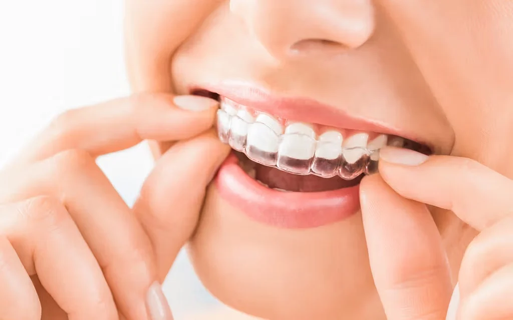 Cfare duhet te dini para se te filloni drejtimin e dhembeve me maskerina dentare.